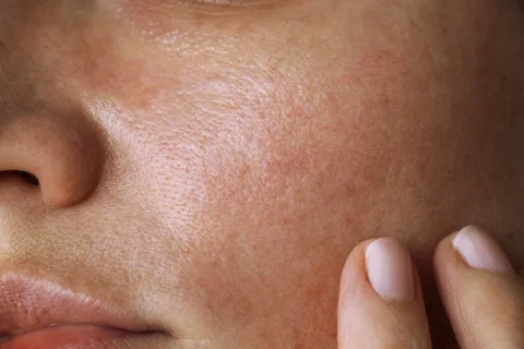 Balancing Oily Skin with Rose Oil
