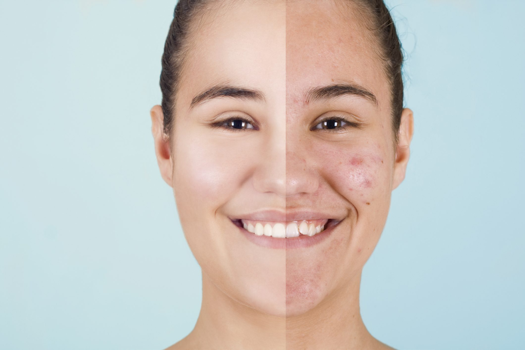 Acne-Prone Skin and rose oil